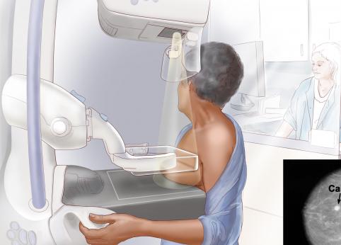 چه کسانی باید ماموگرافی انجام دهند؛ فواید و خطرات ماموگرافی
